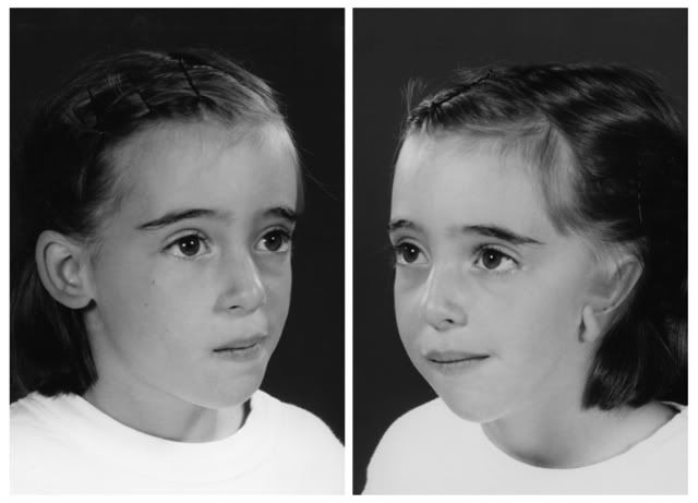 This how Hemi facial microsomia didn;t